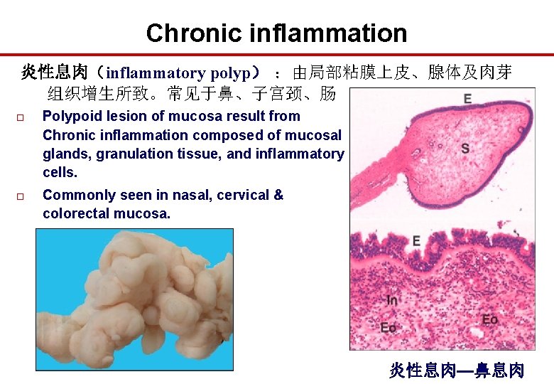 Chronic inflammation 炎性息肉（inflammatory polyp） ：由局部粘膜上皮、腺体及肉芽 组织增生所致。常见于鼻、子宫颈、肠 o Polypoid lesion of mucosa result from Chronic