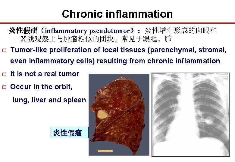 Chronic inflammation 炎性假瘤（inflammatory pseudotumor）：炎性增生形成的肉眼和 Ⅹ线观察上与肿瘤相似的团块。常见于眼眶、肺 o Tumor-like proliferation of local tissues (parenchymal, stromal, even