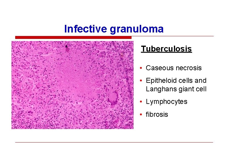 Infective granuloma Tuberculosis • Caseous necrosis • Epitheloid cells and Langhans giant cell •