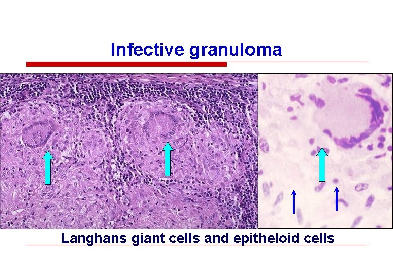 Infective granuloma Langhans giant cells and epitheloid cells 