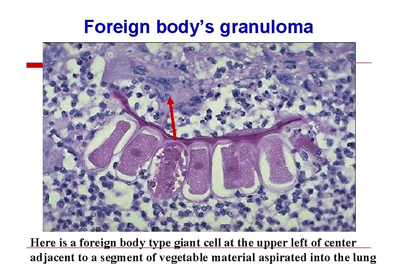 Foreign body’s granuloma Here is a foreign body type giant cell at the upper