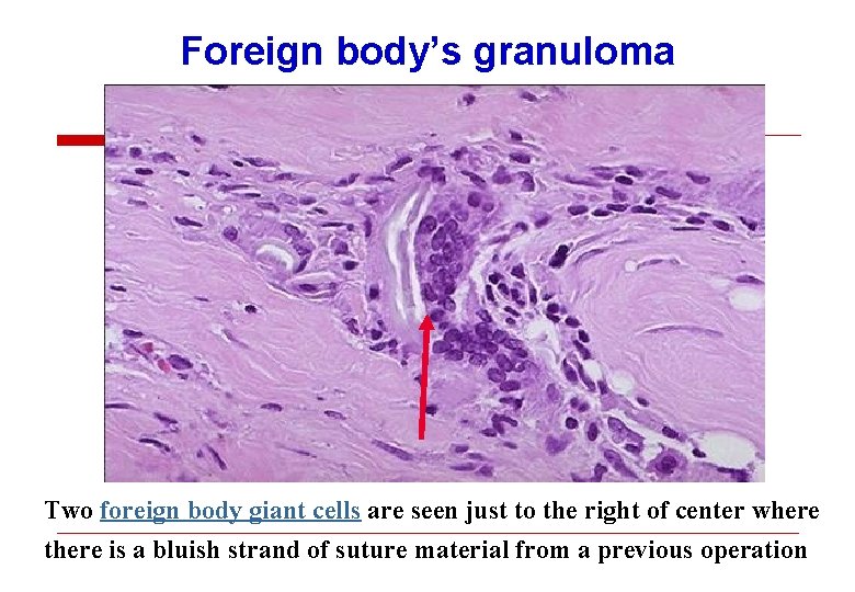 Foreign body’s granuloma Two foreign body giant cells are seen just to the right