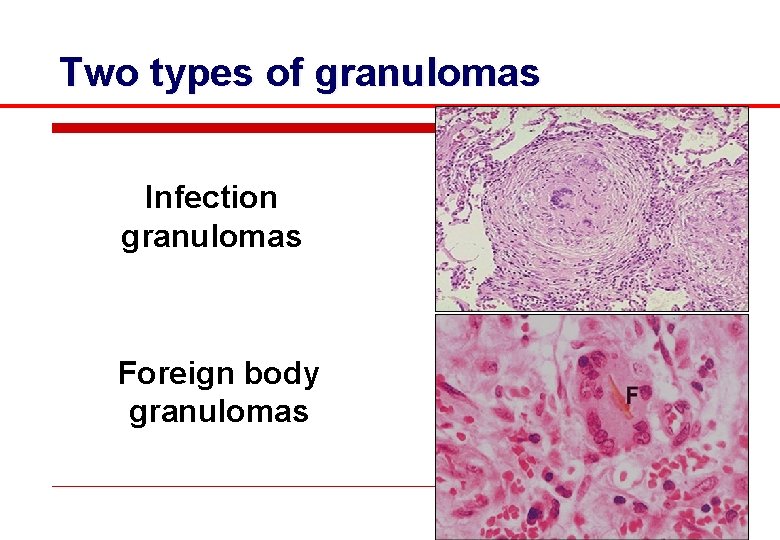 Two types of granulomas Infection granulomas Foreign body granulomas 