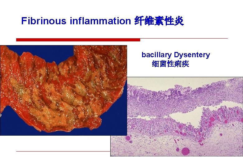 Fibrinous inflammation 纤维素性炎 bacillary Dysentery 细菌性痢疾 