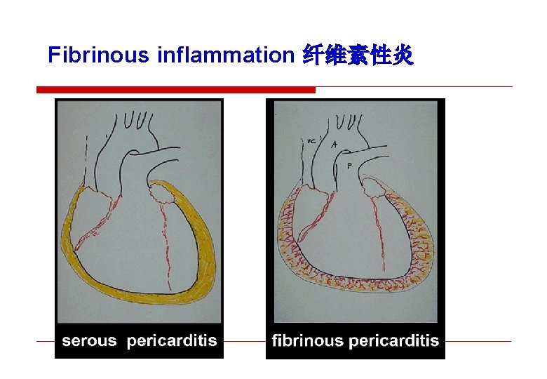Fibrinous inflammation 纤维素性炎 
