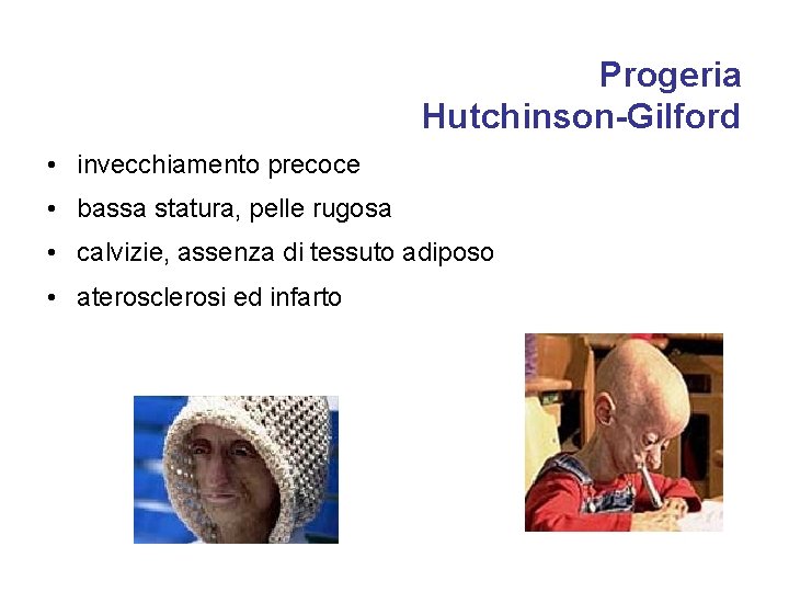 Progeria Hutchinson-Gilford • invecchiamento precoce • bassa statura, pelle rugosa • calvizie, assenza di