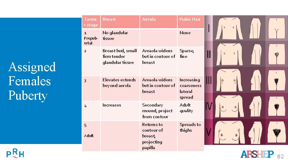 Tanne Breast r stage Aerola 1 No glandular Prepub- tissue Pubic Hair None ertal