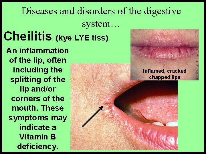 Diseases and disorders of the digestive system… Cheilitis (kye LYE tiss) An inflammation of