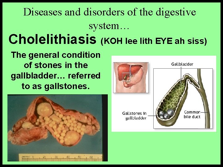 Diseases and disorders of the digestive system… Cholelithiasis (KOH lee lith EYE ah siss)