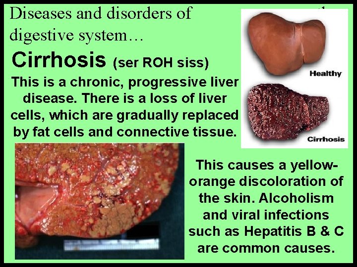 Diseases and disorders of digestive system… the Cirrhosis (ser ROH siss) This is a