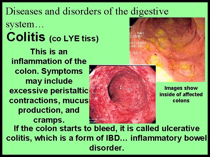 Diseases and disorders of the digestive system… Colitis (co LYE tiss) This is an