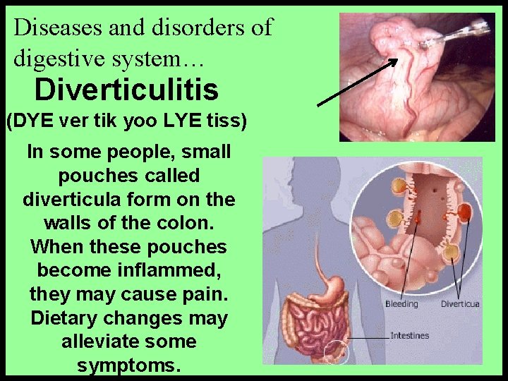 Diseases and disorders of digestive system… Diverticulitis (DYE ver tik yoo LYE tiss) In