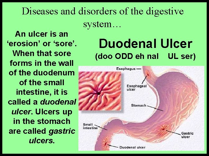 Diseases and disorders of the digestive system… An ulcer is an ‘erosion’ or ‘sore’.