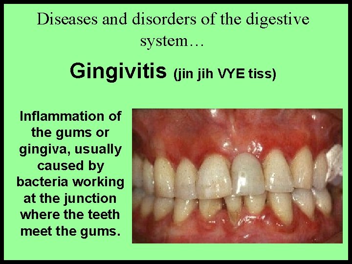 Diseases and disorders of the digestive system… Gingivitis (jin jih VYE tiss) Inflammation of