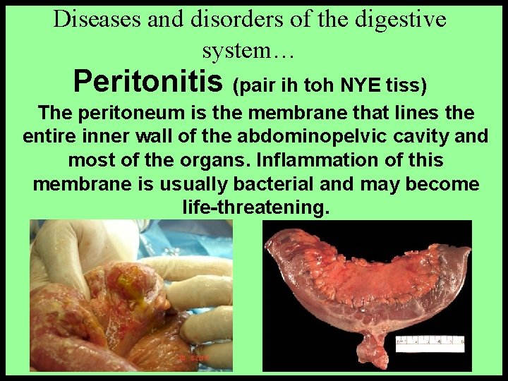 Diseases and disorders of the digestive system… Peritonitis (pair ih toh NYE tiss) The
