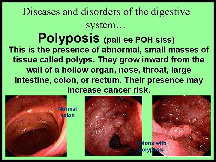 Diseases and disorders of the digestive system… Polyposis (pall ee POH siss) This is