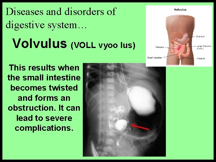 Diseases and disorders of digestive system… Volvulus (VOLL vyoo lus) This results when the
