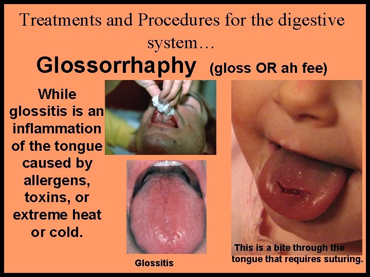 Treatments and Procedures for the digestive system… Glossorrhaphy (gloss OR ah fee) While glossitis