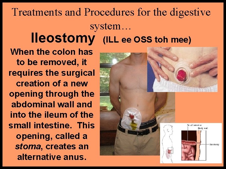 Treatments and Procedures for the digestive system… Ileostomy When the colon has to be