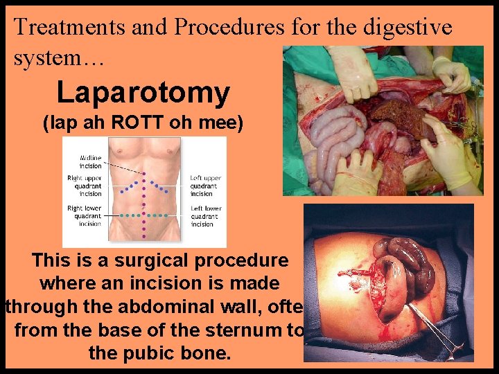 Treatments and Procedures for the digestive system… Laparotomy (lap ah ROTT oh mee) This