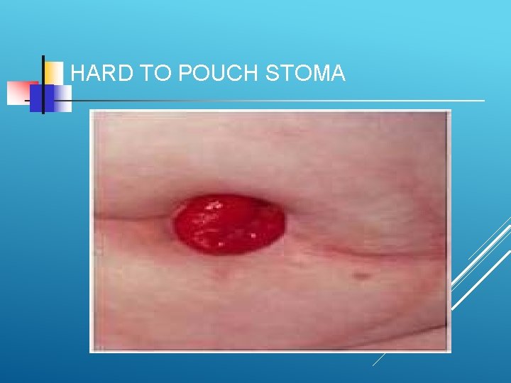 HARD TO POUCH STOMA 
