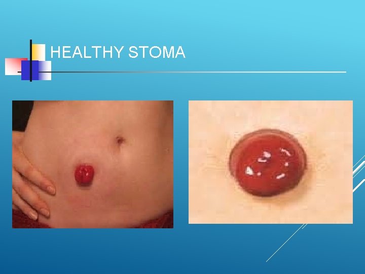 HEALTHY STOMA 