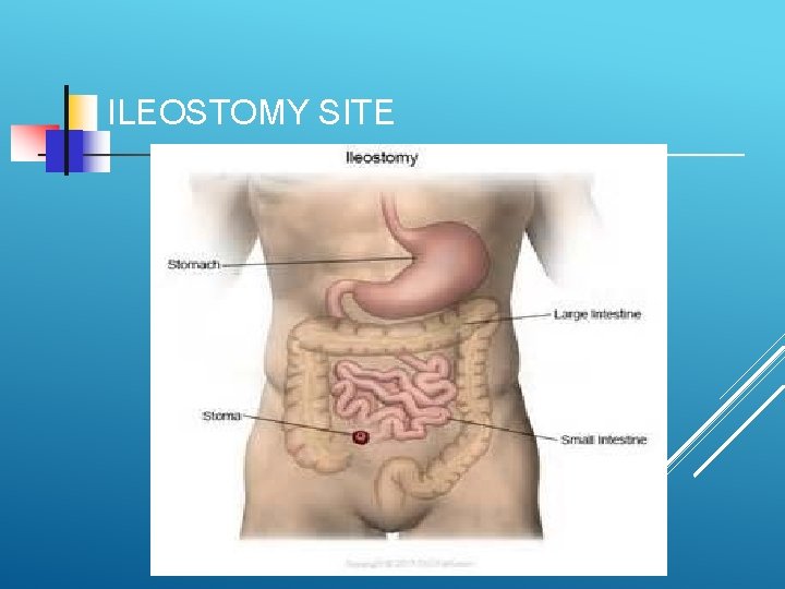 ILEOSTOMY SITE 