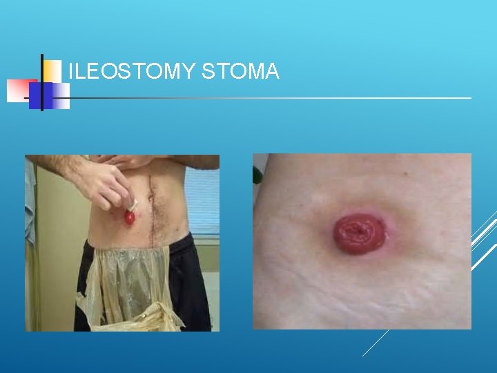 ILEOSTOMY STOMA 