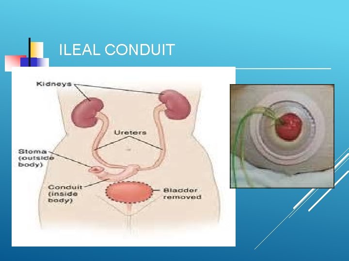 ILEAL CONDUIT 