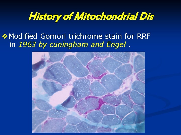 History of Mitochondrial Dis v. Modified Gomori trichrome stain for RRF in 1963 by History of Mitochondrial Dis v. Modified Gomori trichrome stain for RRF in 1963 by