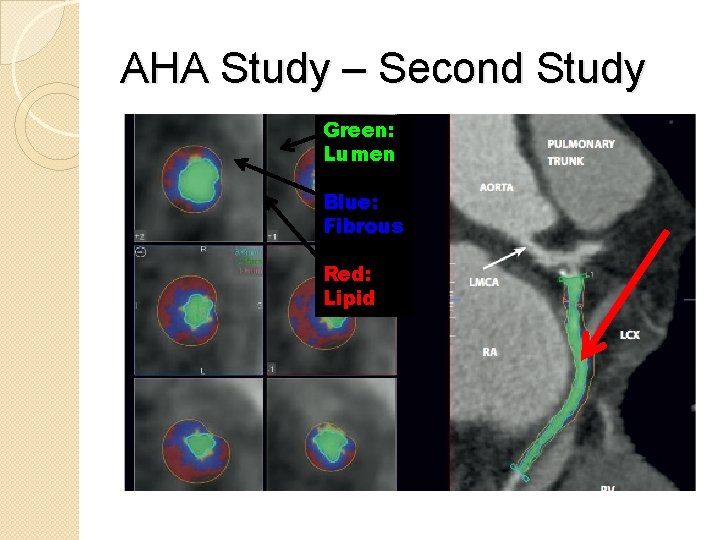 AHA Study – Second Study Green: Lumen Blue: Fibrous Red: Lipid 