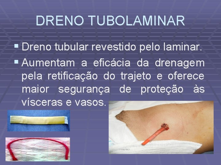 DRENO TUBOLAMINAR Dreno tubular revestido pelo laminar. Aumentam a eficácia da drenagem pela retificação