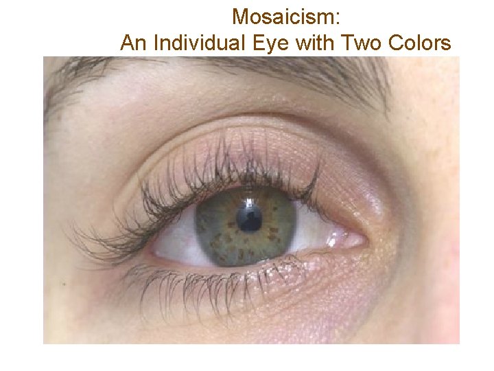 Mosaicism: An Individual Eye with Two Colors 