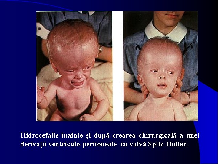 Hidrocefalie înainte şi după crearea chirurgicală a unei derivaţii ventriculo-peritoneale cu valvă Spitz-Holter. 