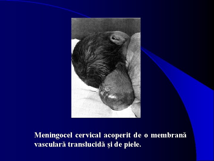 Meningocel cervical acoperit de o membrană vasculară translucidă şi de piele. 