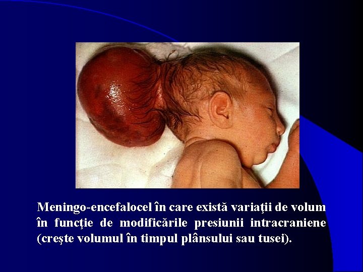 Meningo-encefalocel în care există variaţii de volum în funcţie de modificările presiunii intracraniene (creşte