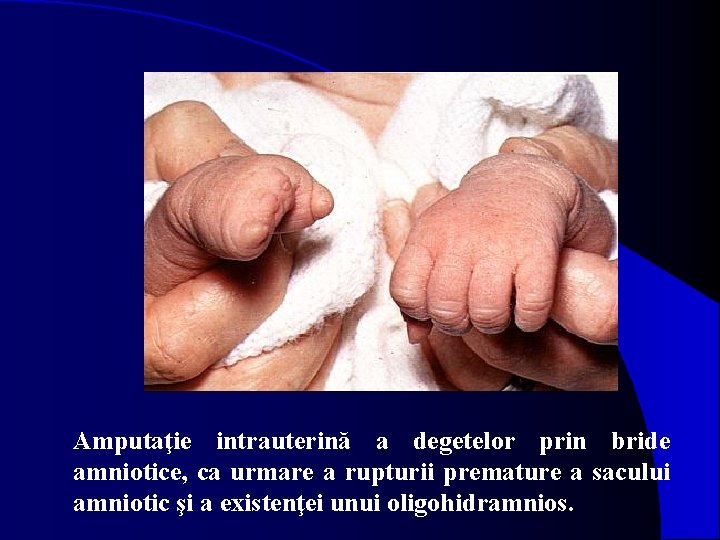 Amputaţie intrauterină a degetelor prin bride amniotice, ca urmare a rupturii premature a sacului