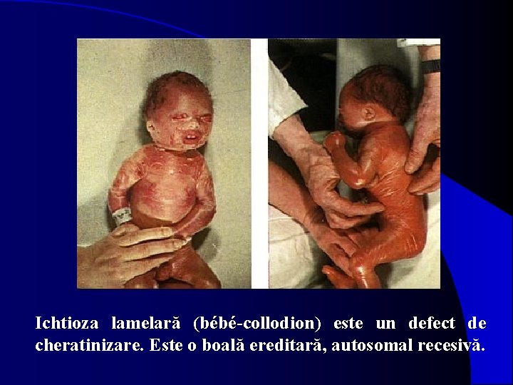 Ichtioza lamelară (bébé-collodion) este un defect de cheratinizare. Este o boală ereditară, autosomal recesivă.