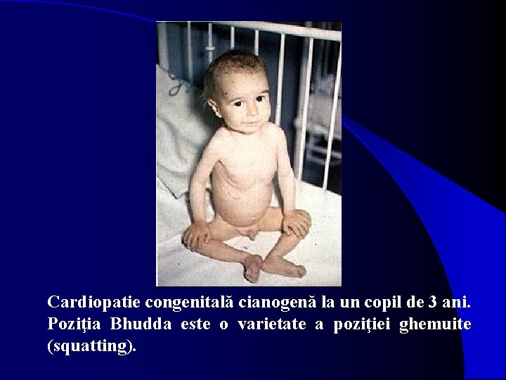 Cardiopatie congenitală cianogenă la un copil de 3 ani. Poziţia Bhudda este o varietate
