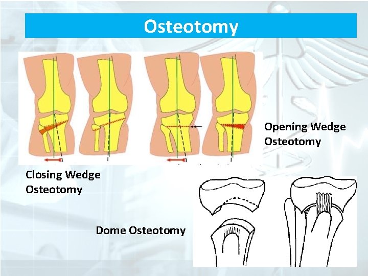 Osteotomy Opening Wedge Osteotomy Closing Wedge Osteotomy Dome Osteotomy 