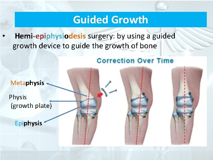 Guided Growth • Hemi-epiphysiodesis surgery: by using a guided growth device to guide the