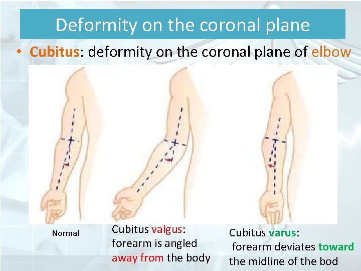 Deformity on the coronal plane • Cubitus: deformity on the coronal plane of elbow