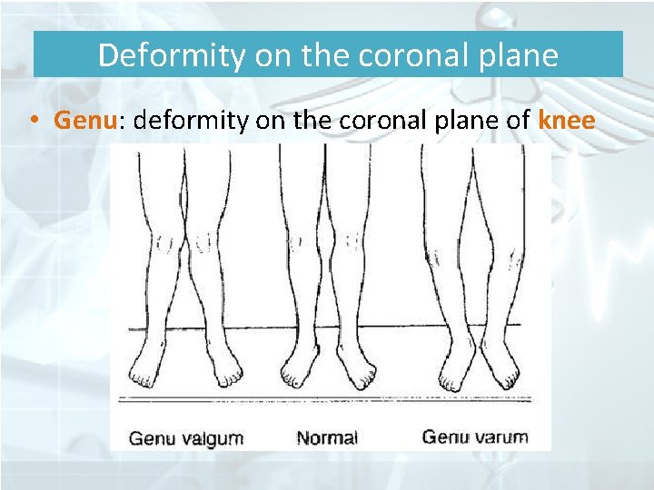 Deformity on the coronal plane • Genu: deformity on the coronal plane of knee