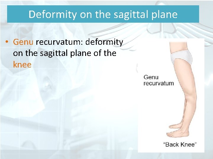 Deformity on the sagittal plane • Genu recurvatum: deformity on the sagittal plane of