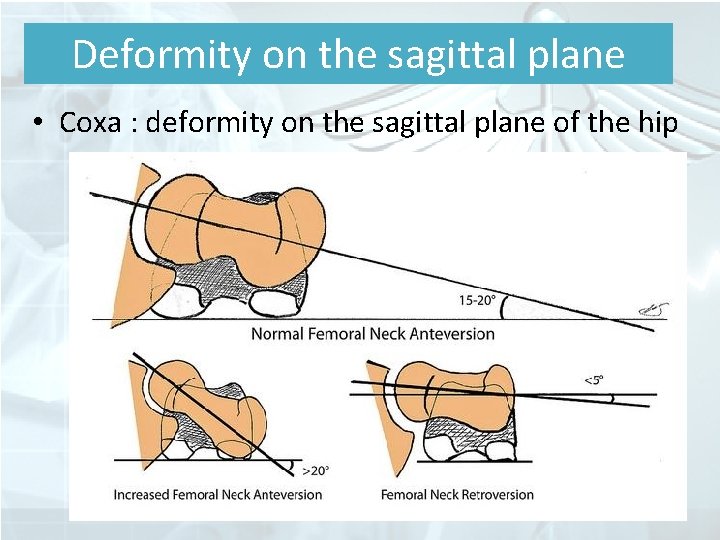 Deformity on the sagittal plane • Coxa : deformity on the sagittal plane of