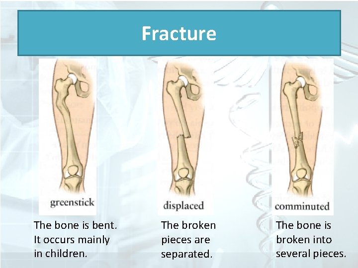 Fracture The bone is bent. It occurs mainly in children. The broken pieces are