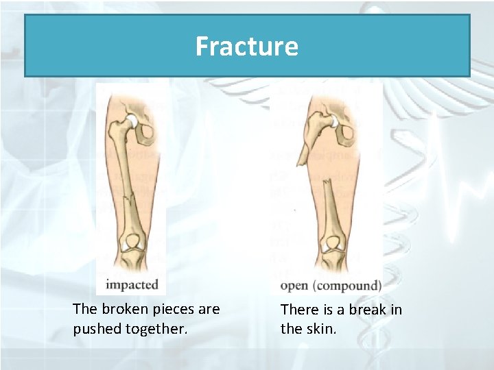 Fracture The broken pieces are pushed together. There is a break in the skin.