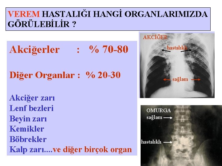 VEREM HASTALIĞI HANGİ ORGANLARIMIZDA GÖRÜLEBİLİR ? AKCİĞER Akciğerler : % 70 -80 hastalıklı Diğer