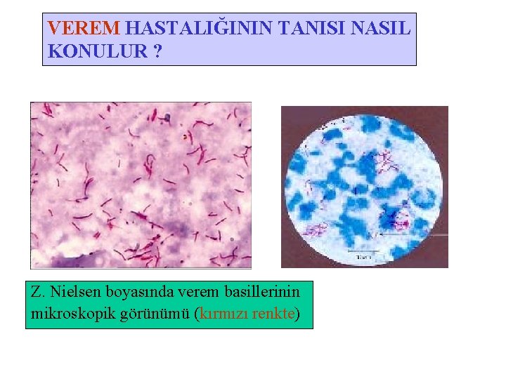 VEREM HASTALIĞININ TANISI NASIL KONULUR ? Z. Nielsen boyasında verem basillerinin mikroskopik görünümü (kırmızı