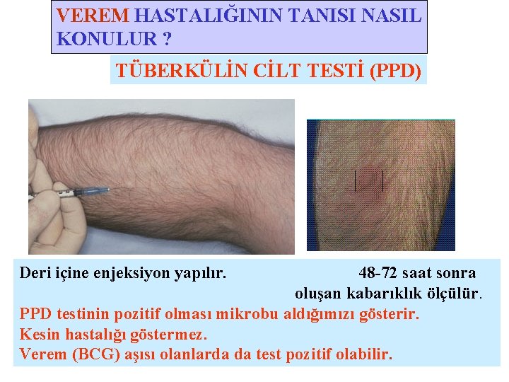 VEREM HASTALIĞININ TANISI NASIL KONULUR ? TÜBERKÜLİN CİLT TESTİ (PPD) Deri içine enjeksiyon yapılır.